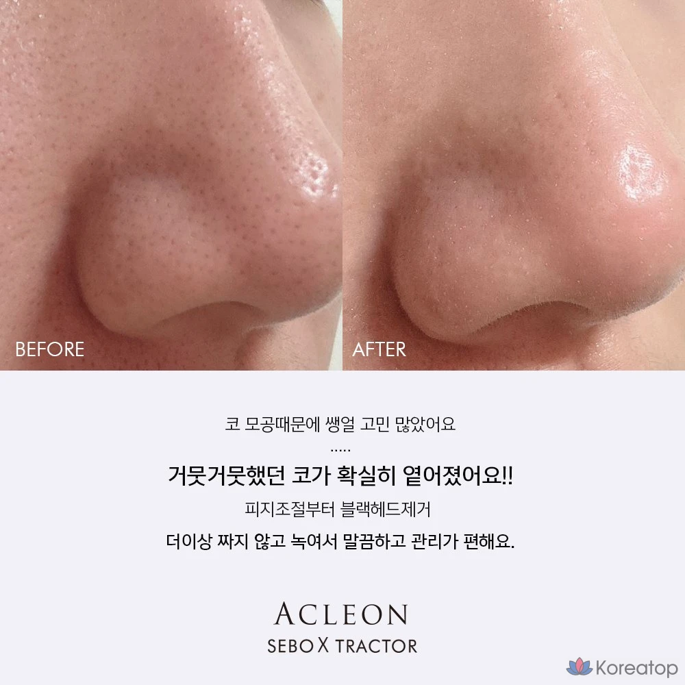 Смягчающее кожное сало ANACIS Seboex, сужение пор, удаление черных точек, очищение кожи головы, 1 шт., 200 мл