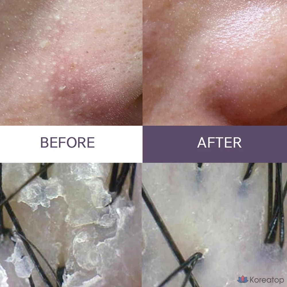 Смягчающее кожное сало ANACIS Seboex, сужение пор, удаление черных точек, очищение кожи головы, 1 шт., 200 мл