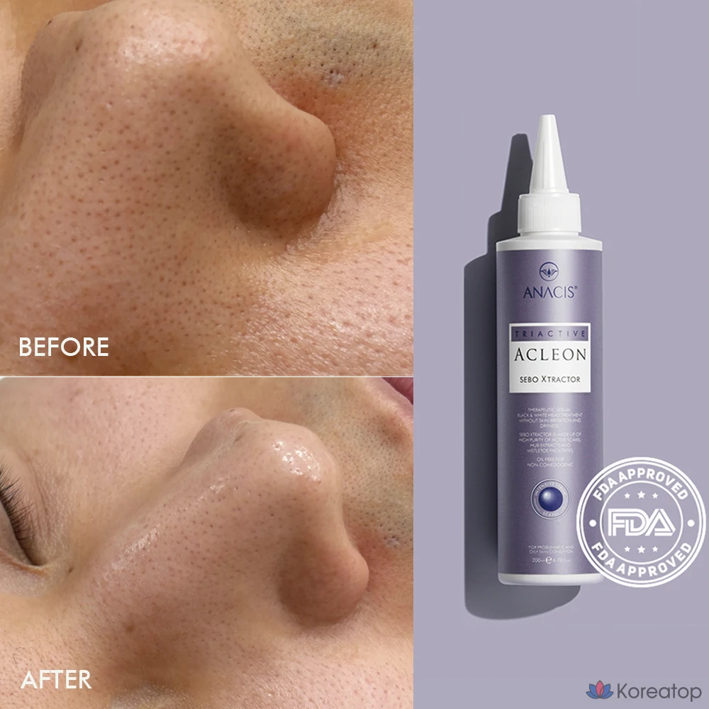 Смягчающее кожное сало ANACIS Seboex, сужение пор, удаление черных точек, очищение кожи головы, 1 шт., 200 мл