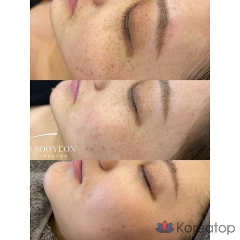 Крем для удаления пигментных пятен Perilla Cream, 20 мл