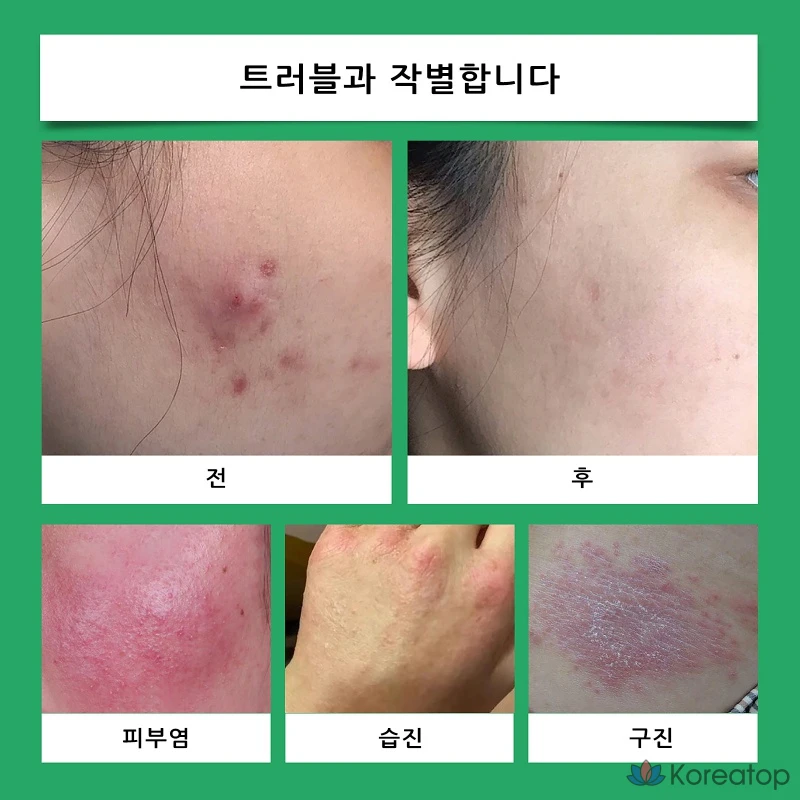 Крем для регенерации кожи Madeca с экстрактом центеллы азиатской, высококонцентрированный отбеливающий крем, интенсивное увлажнение, разглаживание морщин, успокаивающее увлажнение, уход после лазерной эпиляции, восстанавливающий дневной крем, 1 шт., 50 г, фото 2