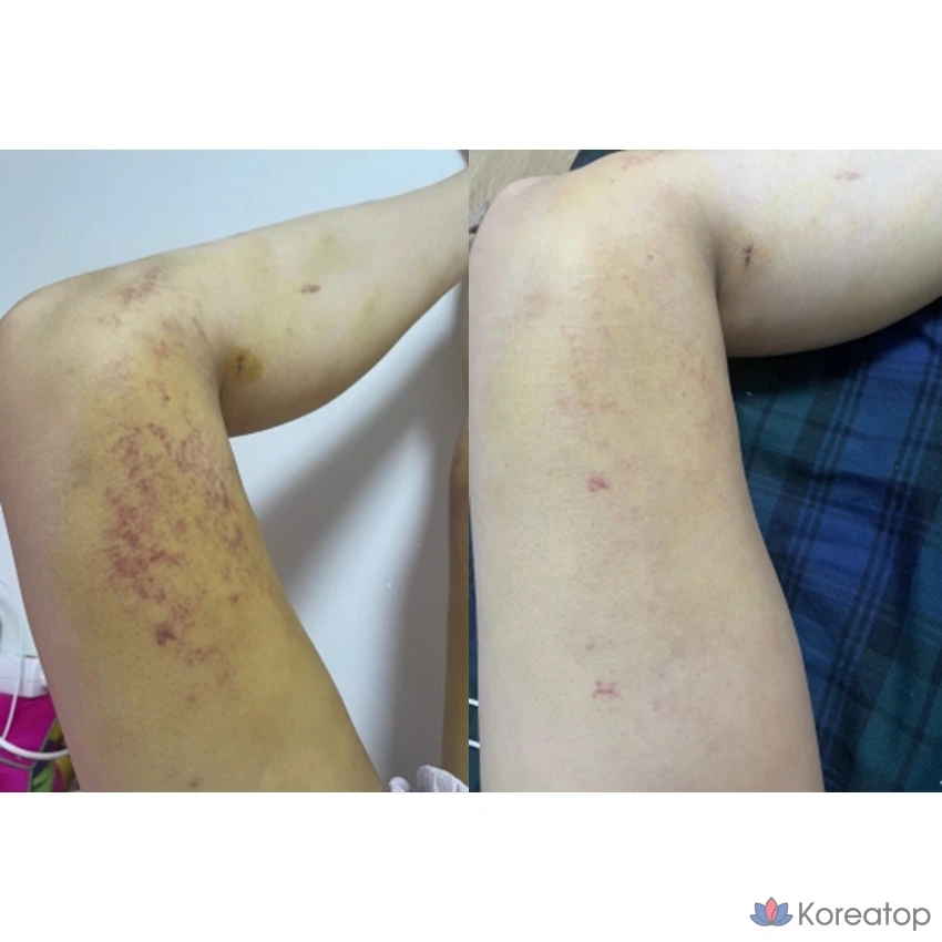 Крем ANACIS K-Oxyderm OP Inmodem с витамином K, 15 мл, 2 упаковки масок Olive Young Mask, 1 упаковка.