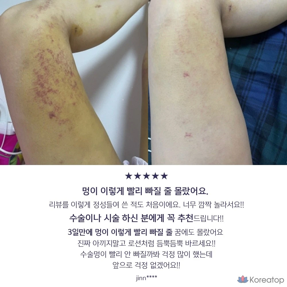 Крем от синяков ANACIS Vitamin K Pharmacy Inmode, 15 мл, 1 шт., 15 г