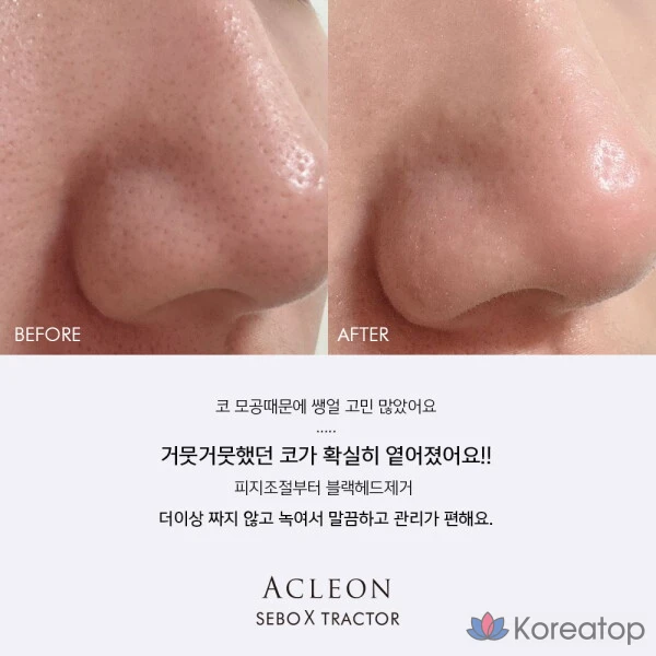 Anacis Acleon Дерматологическое средство для смягчения кожного сала и удаления черных точек, 1000 мл, 1 шт., фото 3