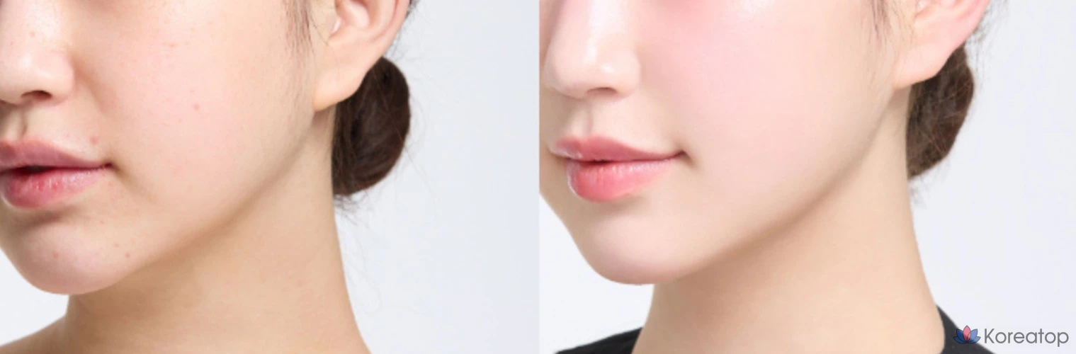 Тональный крем HANSKIN Blemish Cover Comfort Cream Foundation, 30 мл, 1 шт., кремово-бежевый.