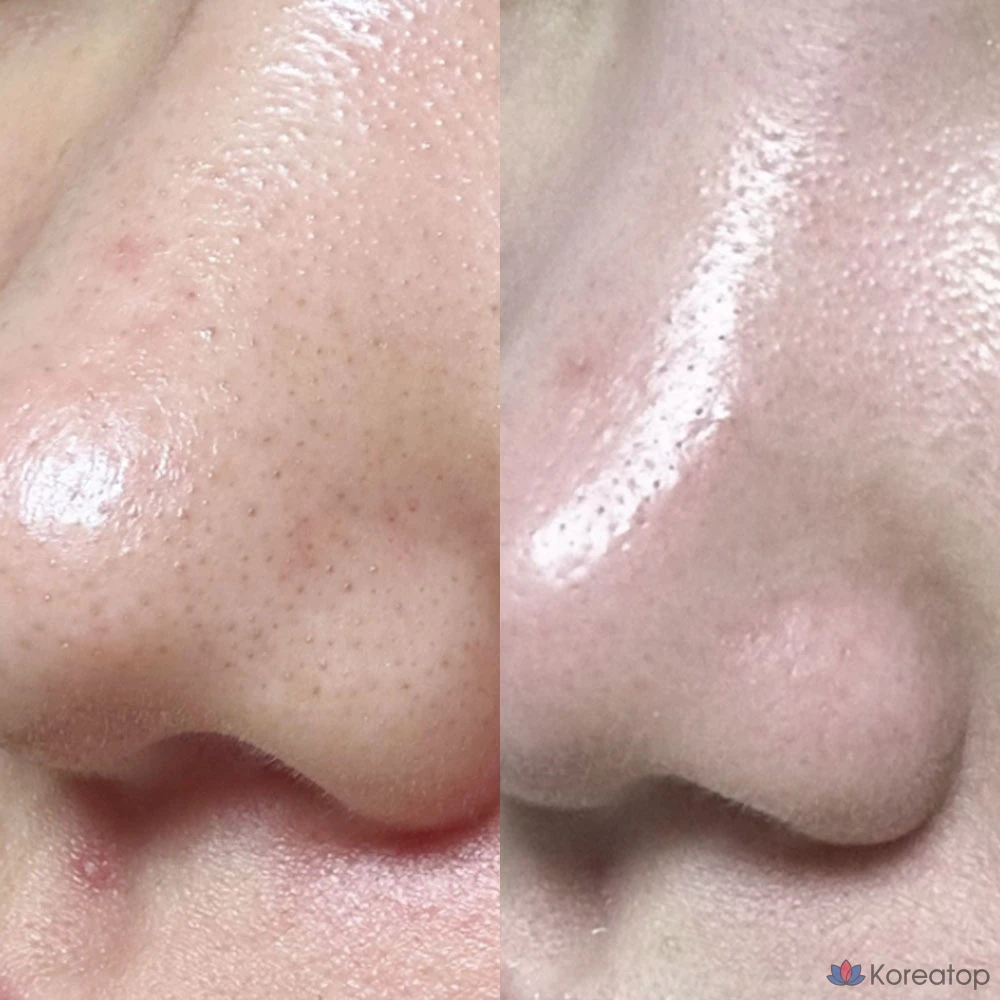 Ампула ANACIS для смягчения кожи при черных точках и угревой сыпи, 2 вида, 1 шт., 255 мл, фото 4