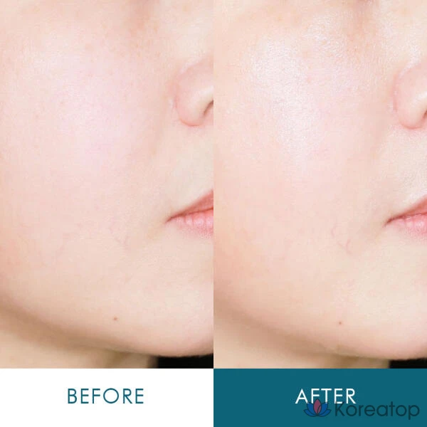 Artbox/ANACIS Leadermiss Resync Средство от акне с гиалуроновой кислотой в ампулах, 55 мл, 1 шт., 20 мл