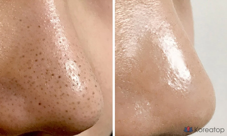 Средство для смягчения кожного сала One-Day's You Sebum-Sucking No Blackhead Sebum Softener, 100 мл, 1 упаковка, 1 шт.